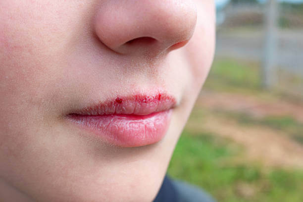 How To Stop Lip Bleeding...