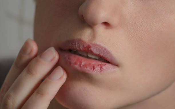 How To Stop Lip Bleeding